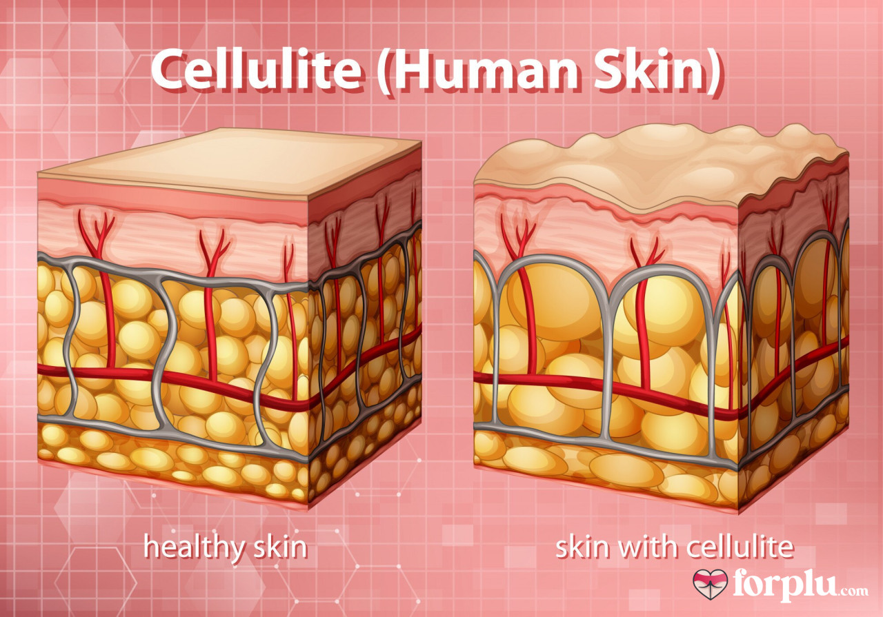 How to Reduce Cellulite Fat Fast Effectively